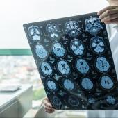 Brainstorm-Concussion Treatment Update