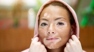Five Skin Conditions & How To Get The Diagnosis Right